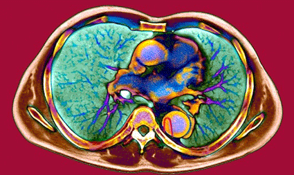 Image: Colored computed tomography (CT) scan of a patient with a dissection of the aorta (Photo courtesy of Du Cane Medical Imaging).